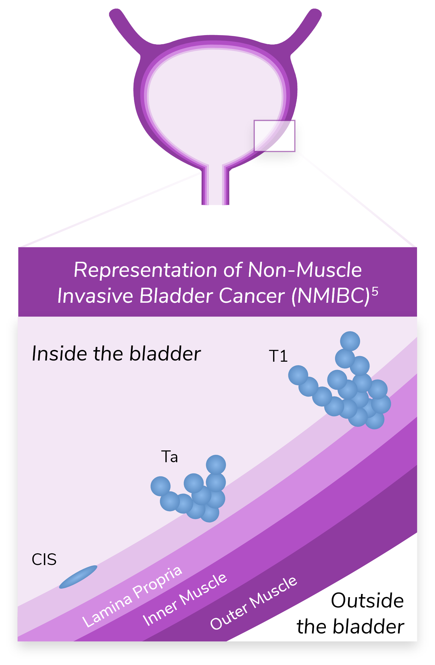 Inset image of a bladder, illustrating the stage at which bladder cancer patients are usually diagnosed